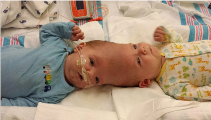 Twin Boys Begin Life Apart After Being Conjoined for 13 Months